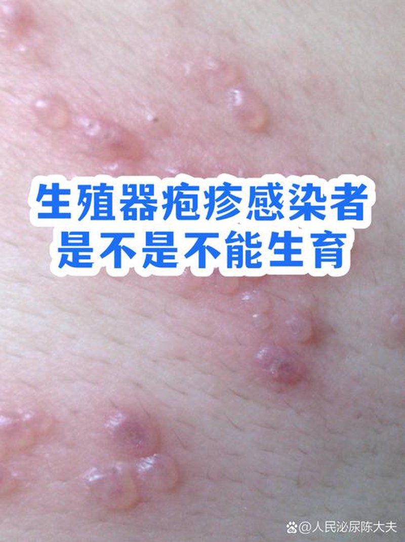 许昌前列腺炎治疗：守护男性健康的重要指南